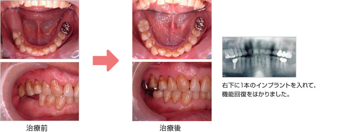 右下に1本のインプラントを入れて、機能回復をはかりました。