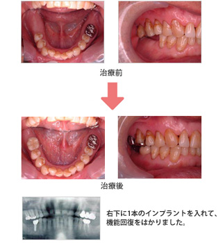 右下に1本のインプラントを入れて、機能回復をはかりました。