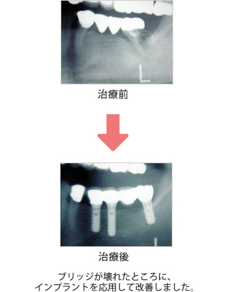 ブリッジが壊れたところに、インプラントを応用して改善しました。