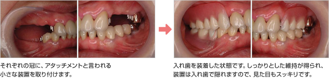 それぞれの冠に、アタッチメントと言われる小さな装置を取り付けます。 入れ歯を装着した状態です。しっかりとした維持が得られ、装置は入れ歯で隠れますので、見た目もスッキリです。