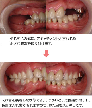 それぞれの冠に、アタッチメントと言われる小さな装置を取り付けます。 入れ歯を装着した状態です。しっかりとした維持が得られ、装置は入れ歯で隠れますので、見た目もスッキリです。