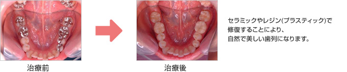 セラミックやレジン(プラスティック)で修復することにより、自然で美しい歯列になります。