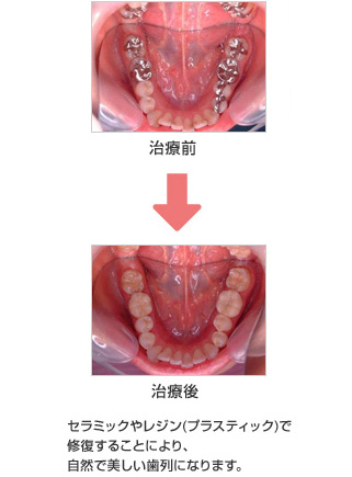 セラミックやレジン(プラスティック)で修復することにより、自然で美しい歯列になります。