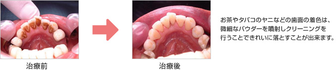 お茶やタバコのヤニなどの歯面の着色は、微細なパウダーを噴射しクリーニングを行うことできれいに落とすことが出来ます。