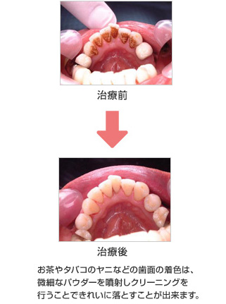 お茶やタバコのヤニなどの歯面の着色は、微細なパウダーを噴射しクリーニングを行うことできれいに落とすことが出来ます。