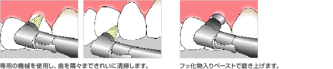 専用の機械を使用し、歯を隅々まできれいに清掃します。 フッ化物入りペーストで磨き上げます。